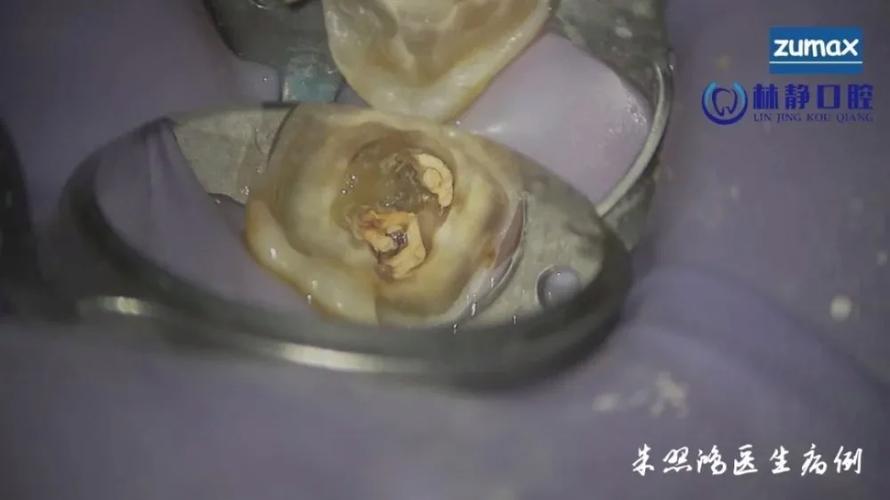 拔完智齿嘴里有根针,物流专线直达_123随叫随到