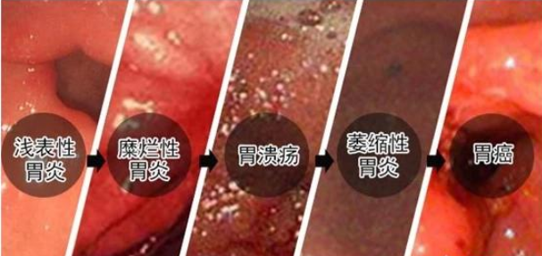 这种胃癌偏爱年轻人,上门取货_123随叫随到