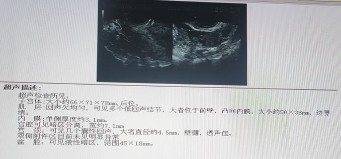 39岁长36枚子宫肌瘤,上门取货_123随叫随到