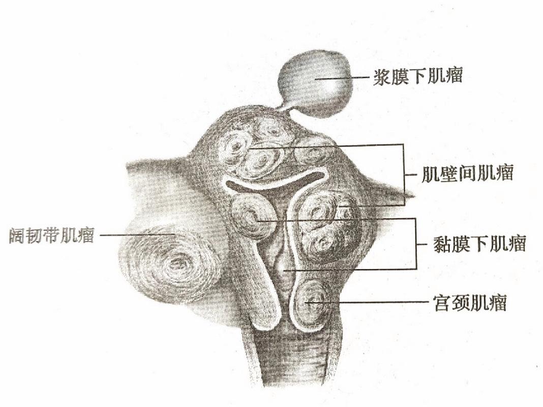 39岁长36枚子宫肌瘤,仓配一体,时效速达